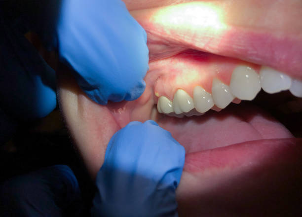 Best Emergency Denture Repair in Issaquah, WA