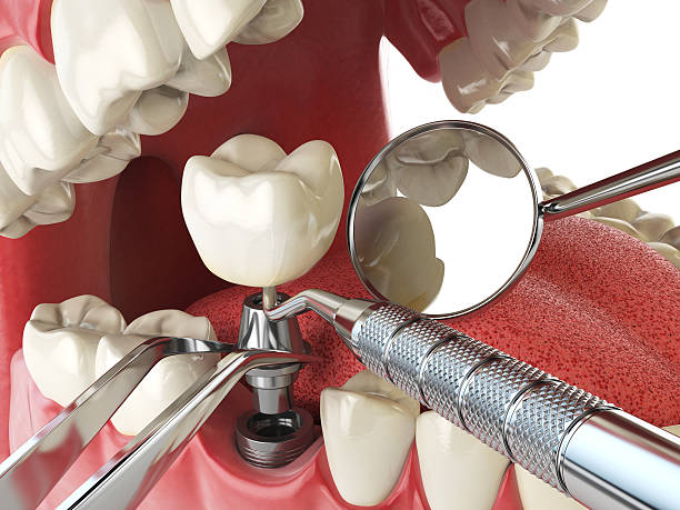 Best Emergency Dental Care for Broken or Chipped Teeth in Issaquah, WA