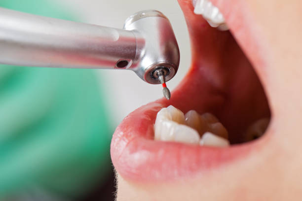 Best Emergency Treatment for Dental Infections or Abscesses in Issaquah, WA